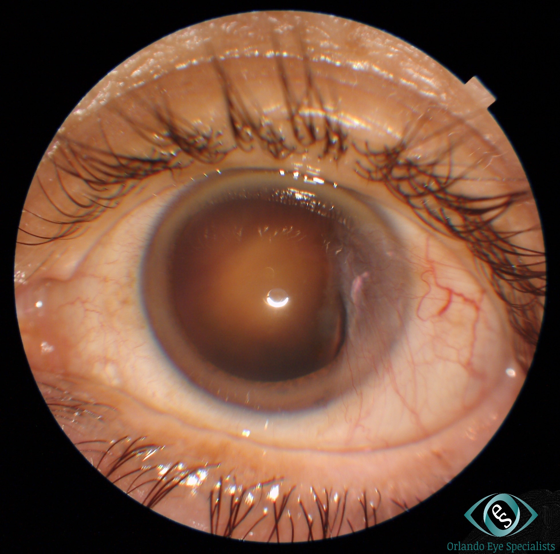 Pterygium – Orlando Eye Specialists